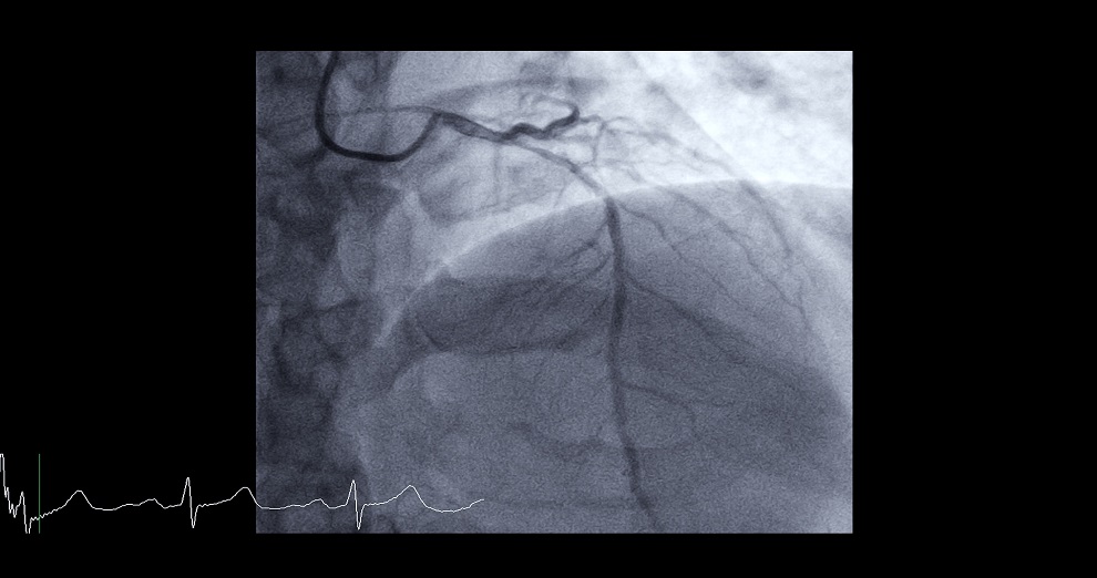 Image: CT coronary angiography for diagnosing coronary artery disease offers advantages over other diagnostic tests (Photo courtesy of 123RF)